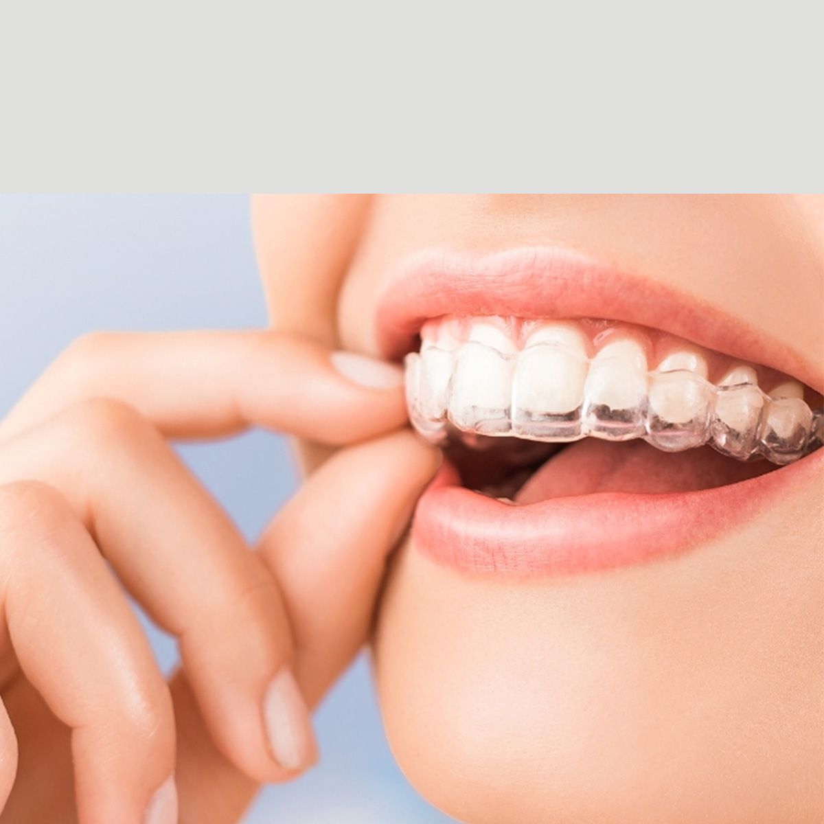 Niềng răng trong suốt Invisalign