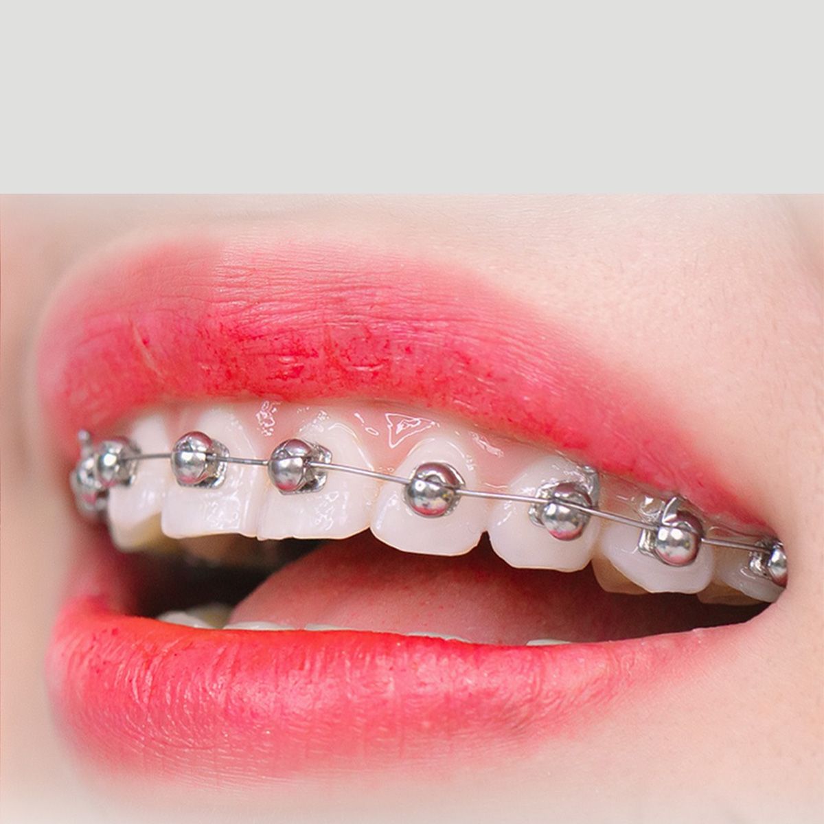 Niềng răng mắc cài kim loại tự khóa