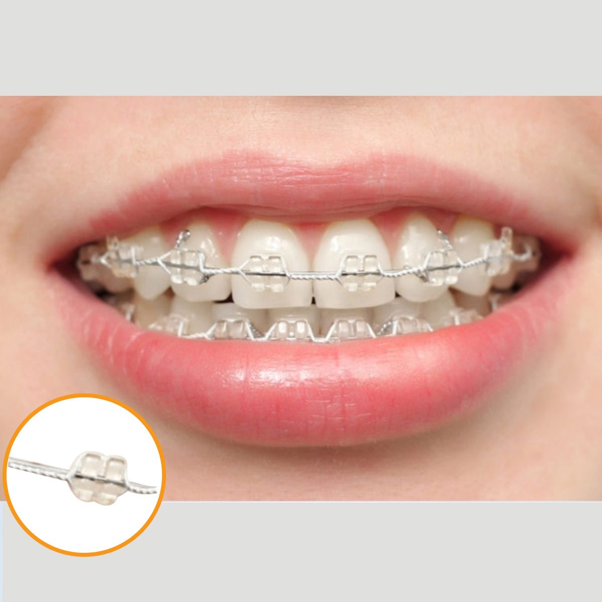 Niềng răng mắc cài pha lê