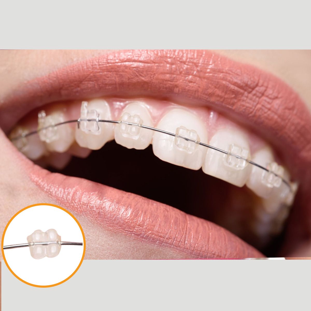 Niềng răng mắc cài sứ