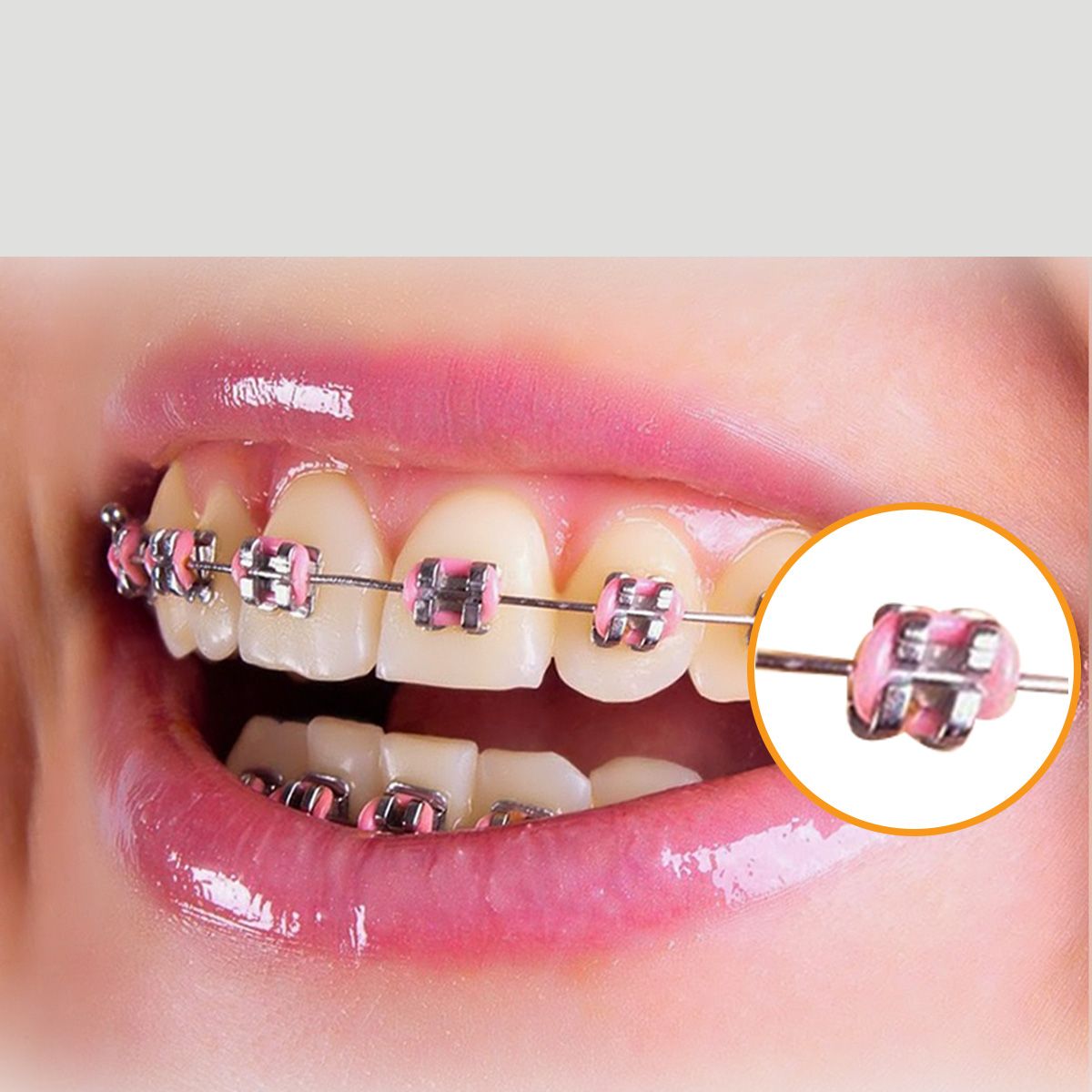 Gói Niềng Răng Mắc Cài Kim Loại