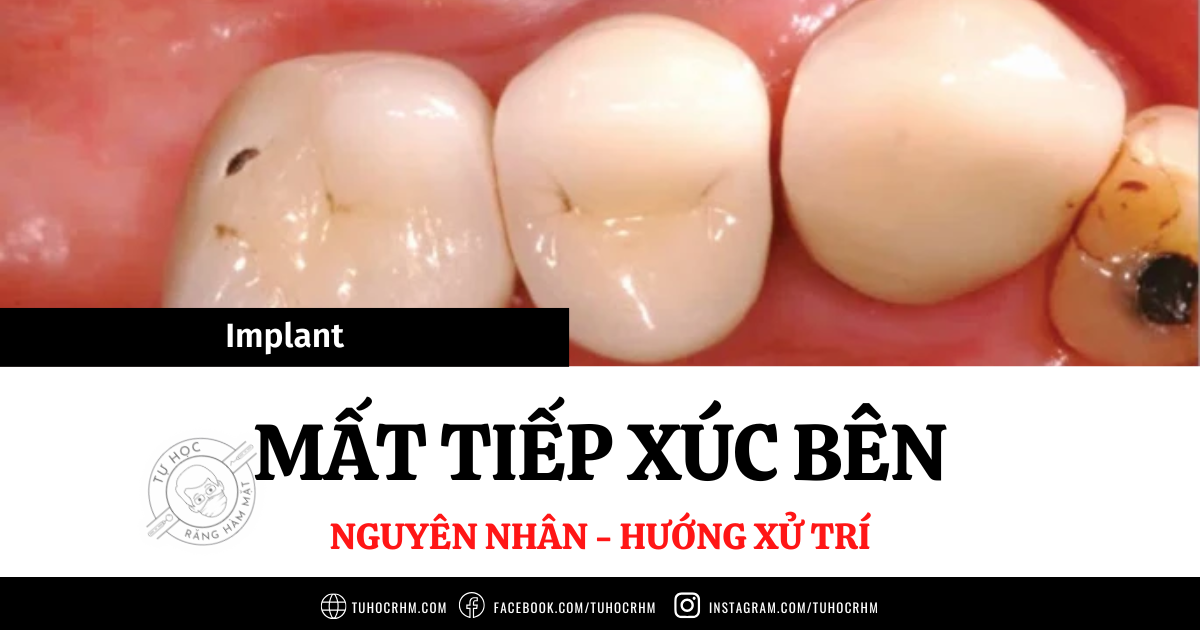 Mất Tiếp Xúc Bên Phục Hình Implant: Nguyên Nhân & Cách Xử Trí (2026)