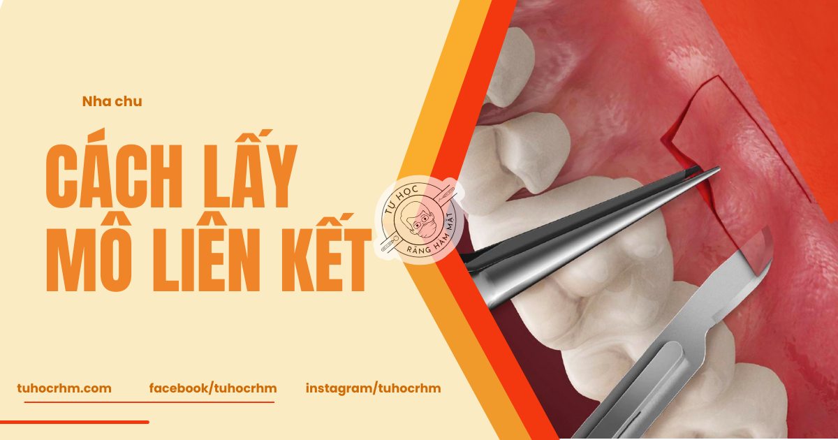 Cách Lấy Mô Liên Kết (CTG) Chuẩn Y Khoa: Kỹ Thuật & Giải Phẫu (2026)