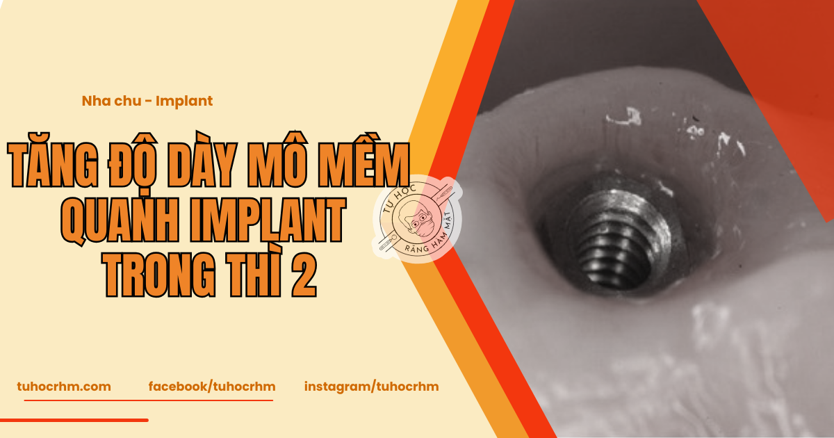 Tăng Độ Dày Mô Mềm Quanh Implant Thì 2 (Phần 2) - Ca Lâm Sàng (2026)