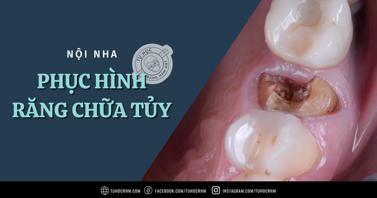 Phục Hình Cho Răng Chữa Tủy: Tiêu Chuẩn & Nguyên Tắc Lựa Chọn (2026)