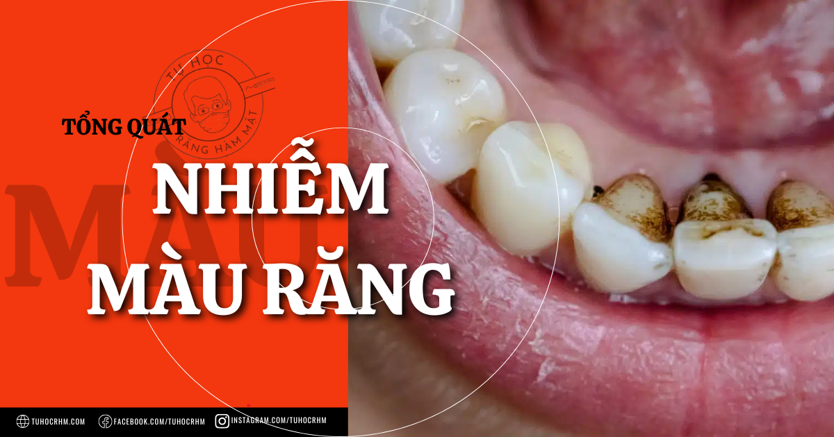 Các Kiểu Nhiễm Màu Trên Răng: Phân Loại & Nguyên Nhân Dẫn Đến (2026)