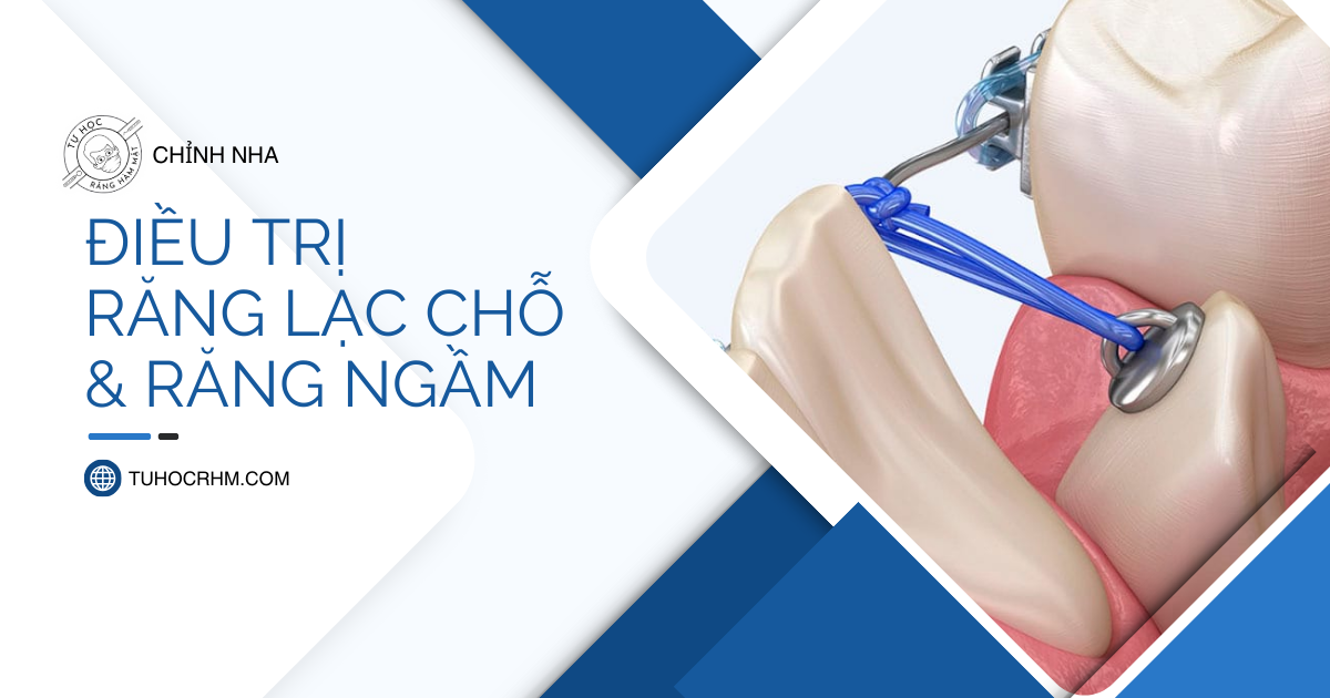 Chỉnh Nha Răng Mọc Lạc Chỗ Và Răng Ngầm: Phác Đồ Chi Tiết (2026)