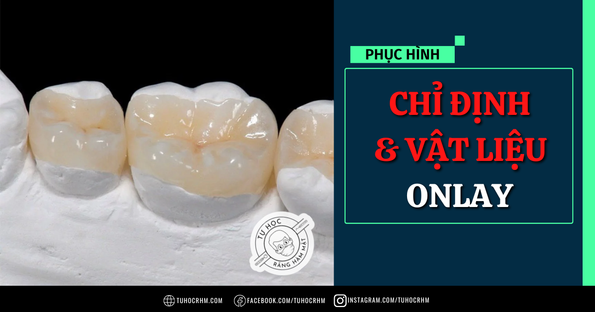 Onlay Dán: Chỉ Định & Vật Liệu Phục Hình Xâm Lấn Tối Thiểu (2026)