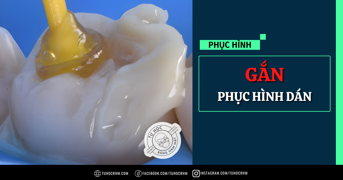 Kỹ Thuật Gắn Phục Hình Dán: Quy Trình Onlay & Veneer (2026)