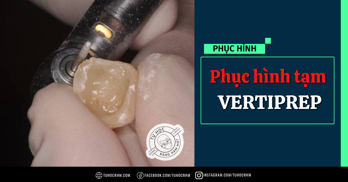 Làm Phục Hình Tạm Vertiprep: Kỹ Thuật & Hướng Dẫn Mô Nướu (2026)