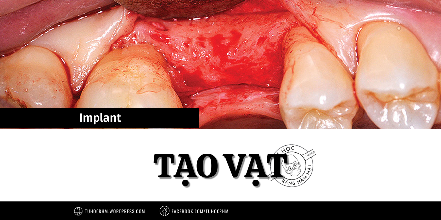 Tạo Vạt Trong Implant: Các Thiết Kế Đường Rạch & Kỹ Thuật (2026)