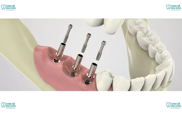 Mất Răng Lâu Năm Có Trồng Implant Được Không? (2026)