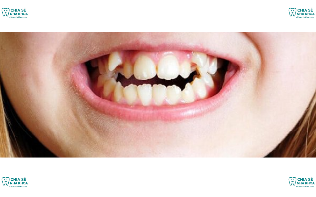 Tại Sao Răng Sữa Chưa Rụng Đã Mọc Răng Mới? Cách Xử Trí Phù Hợp