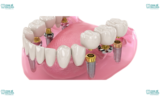 3 Lầm Tưởng Về Trồng Răng Implant 'Công Nghệ Cao' Bạn Cần Biết