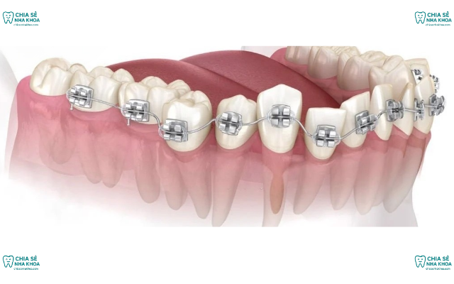 Hậu Quả Kinh Hoàng Từ Bẫy Quảng Cáo Niềng Răng Giá Rẻ