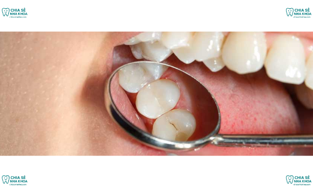 Sự Cần Thiết Của Việc Hàn Răng Sâu & Những Lưu Ý Sau Khi Hàn