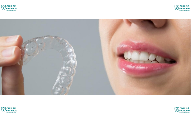 Hàm Duy Trì Sau Niềng Răng Có Thật Sự Quan Có Trọng Không?