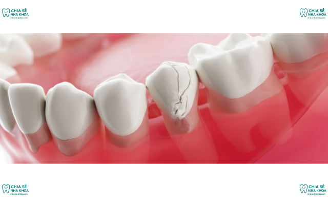 Bị Vỡ Chân Răng Do Nguyên Nhân Nào? Cách Khắc Phục Triệt Để