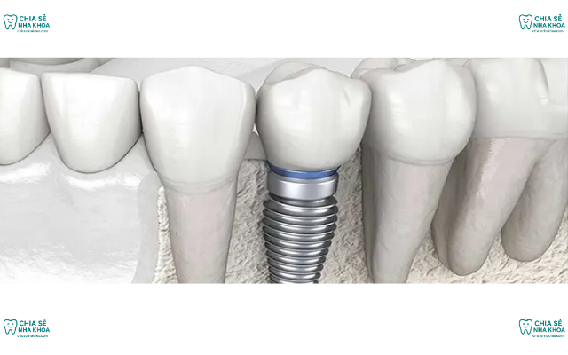 Độ Tuổi Nào Phù Hợp Để Trồng Răng Implant? Góc Nhìn Nha Sĩ