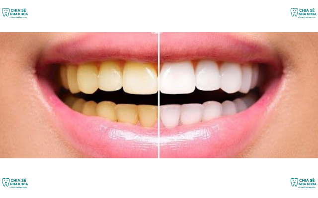 Khi Nào Nên Tẩy Trắng Răng? Chỉ Định Và Phác Đồ An Toàn