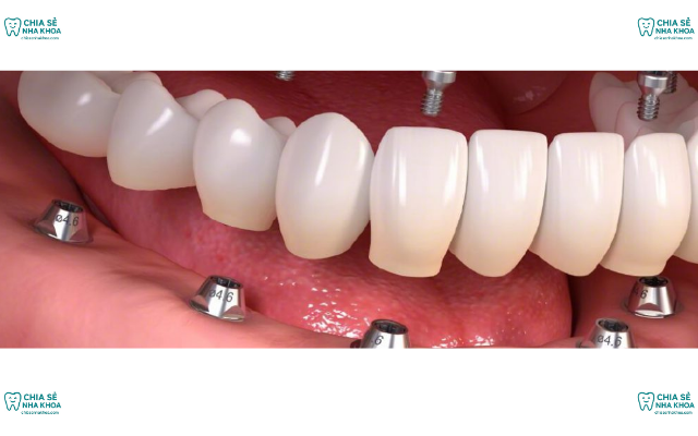 Sự Thật Về Công Nghệ Cấy Ghép Implant Có Thể Bạn Chưa Biết (2026)