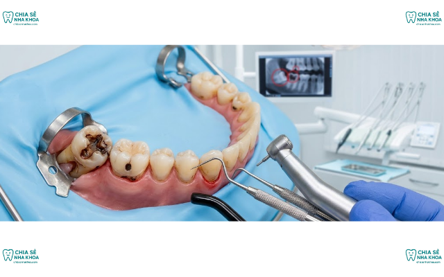 Răng Số 8 Bị Sâu Có Nên Nhổ Không? Hướng Xử Lý An Toàn (2026)