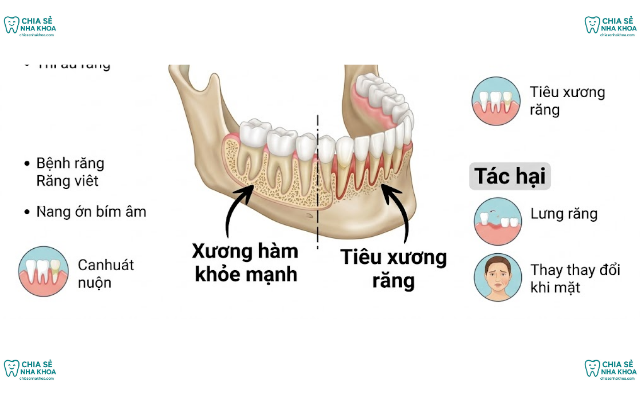 Tiêu Xương Răng: Nguyên Nhân, Tác Hại Và Cách Điều Trị (2026)