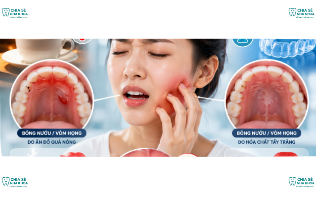 Làm Gì Khi Bị Bỏng Nướu, Vòm Họng Do Đồ Nóng & Thuốc Tẩy Trắng? (2026)
