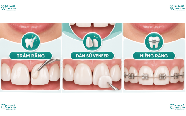 Răng Cửa Thưa 2mm: Nên Trám, Dán Sứ Veneer Hay Niềng? (2026)
