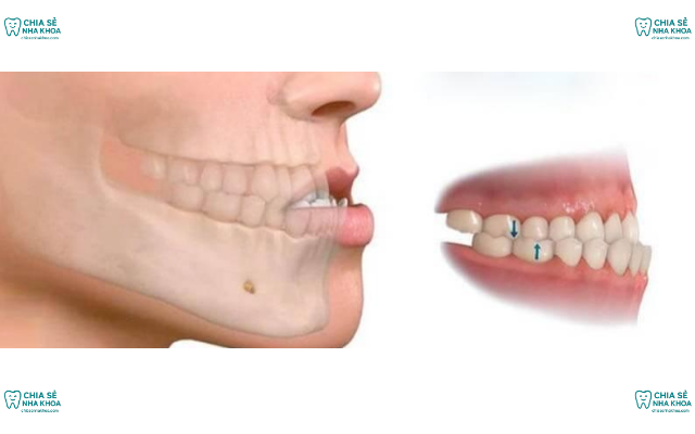 Khớp Cắn Ngược Ở Trẻ Em: Nguyên Nhân & Cách Trị Can Thiệp (2026)