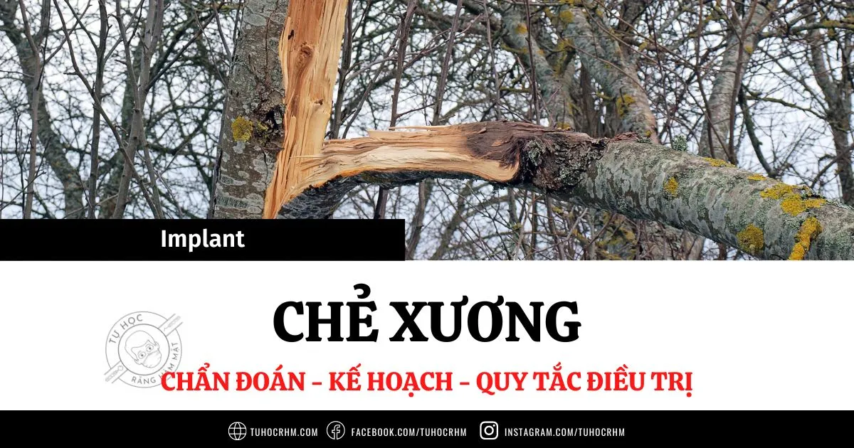 Chẻ Xương (RSEP): Lập Kế Hoạch & Quy Tắc Điều Trị Implant (2026)