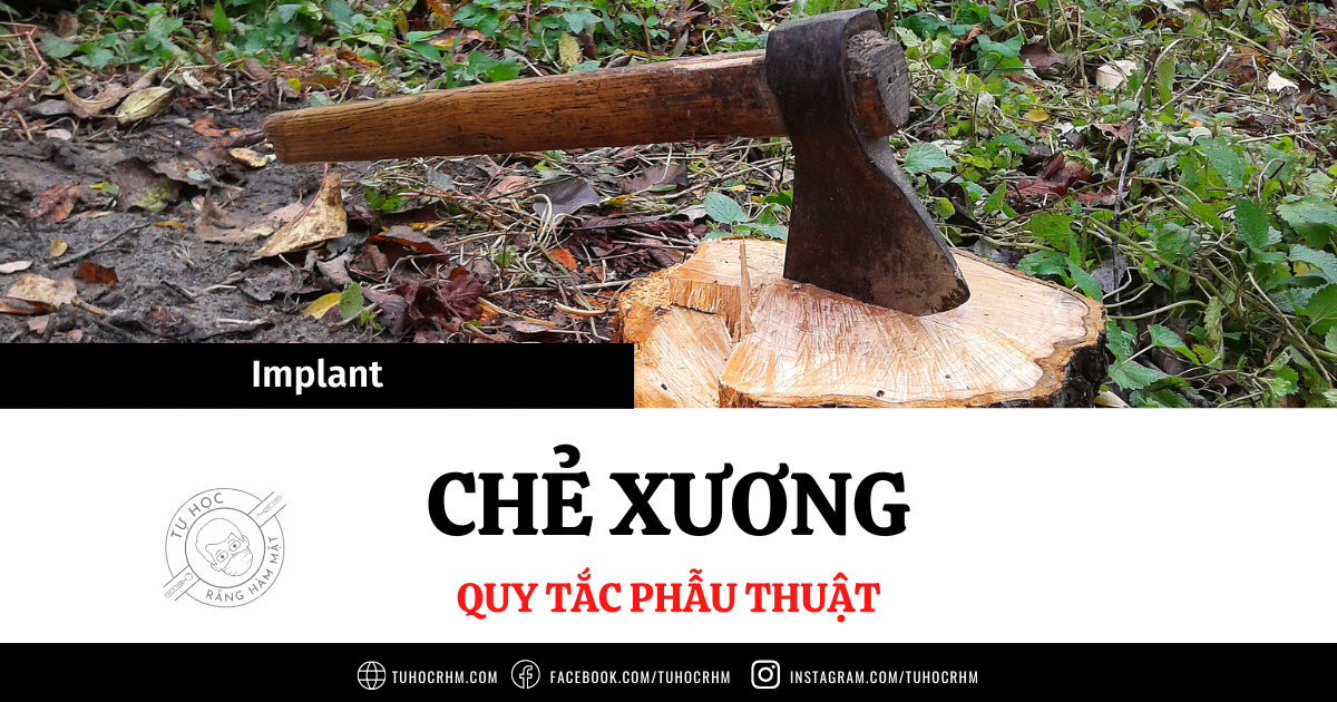 Quy Tắc Chẻ Xương (Mở Rộng Gờ Xương) Trong Implant (2026)