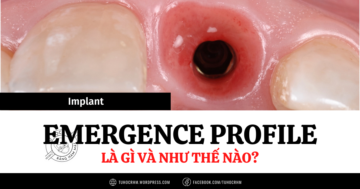 Implant Emergence Profile: Nguyên Tắc Thiết Kế Tránh Tiêu Xương (2026)