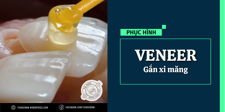 Quy Trình Gắn Xi Măng Veneer Sứ: Xử Lý Bề Mặt & Kỹ Thuật Gắn Chuẩn (2026)