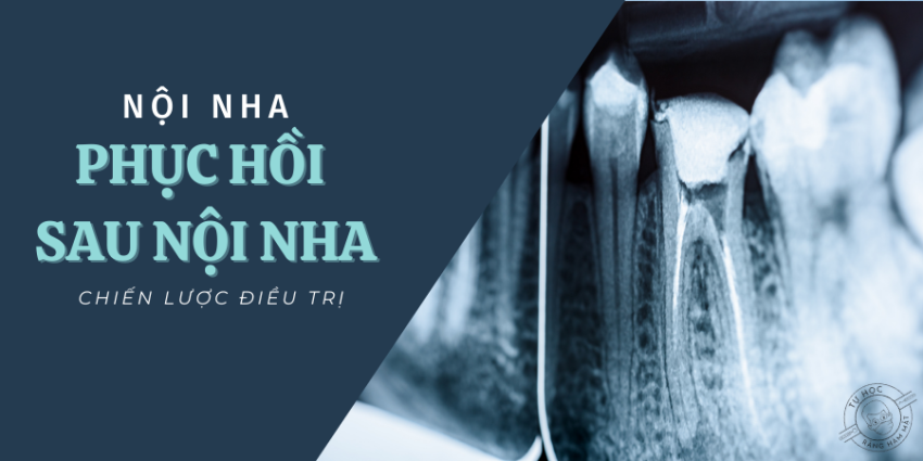 Chiến Lược Phục Hồi Răng Sau Nội Nha: Khi Nào Cần Đặt Chốt? (2026)