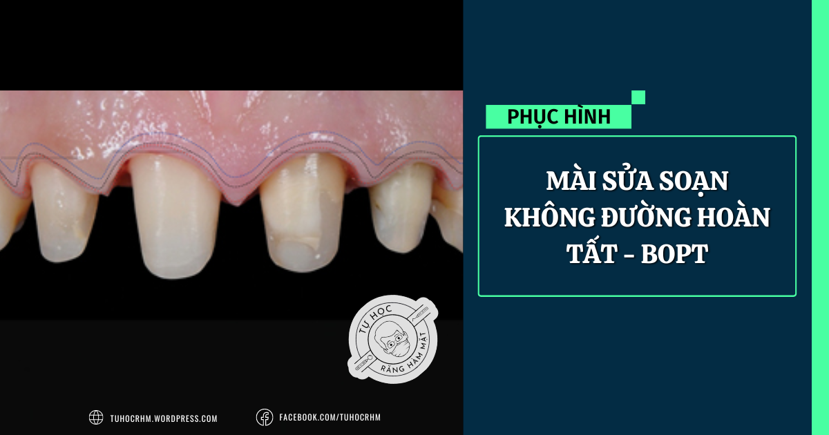 Kỹ Thuật BOPT: Mài Sửa Soạn Răng Không Đường Hoàn Tất (2026)