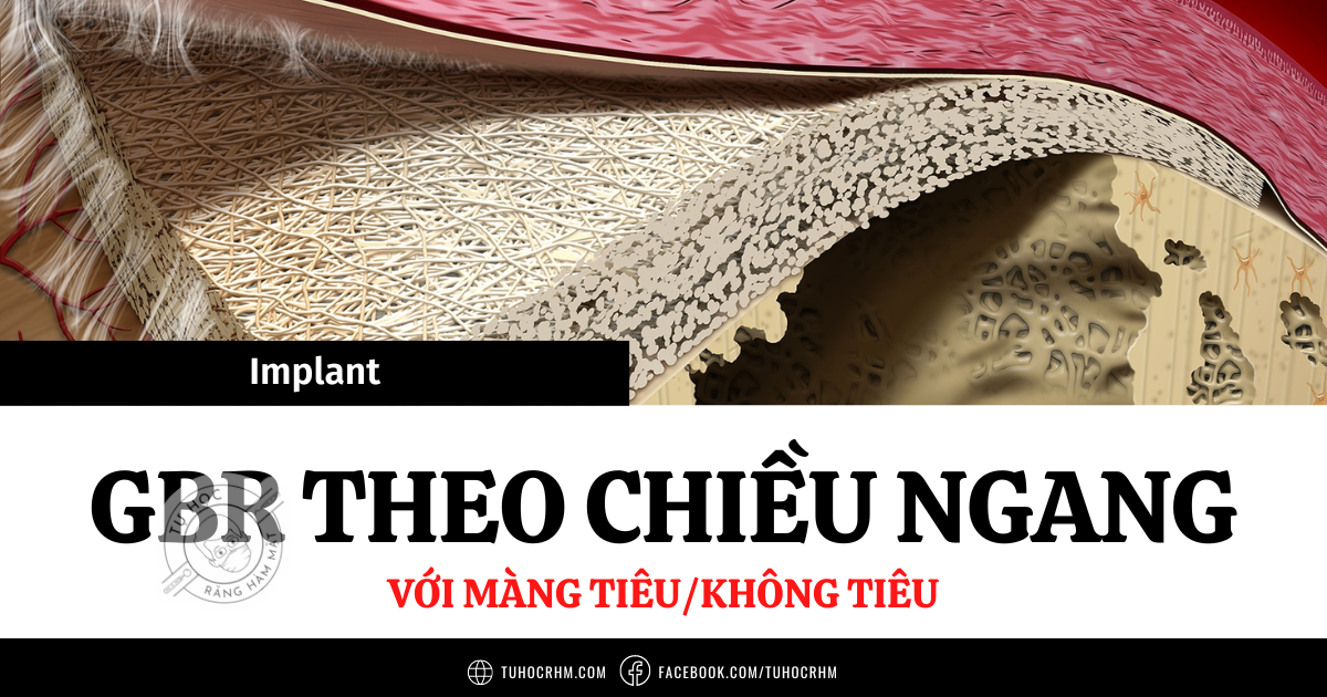 Kỹ Thuật GBR Implant Theo Chiều Ngang Với Màng Tiêu/Không Tiêu (2026)