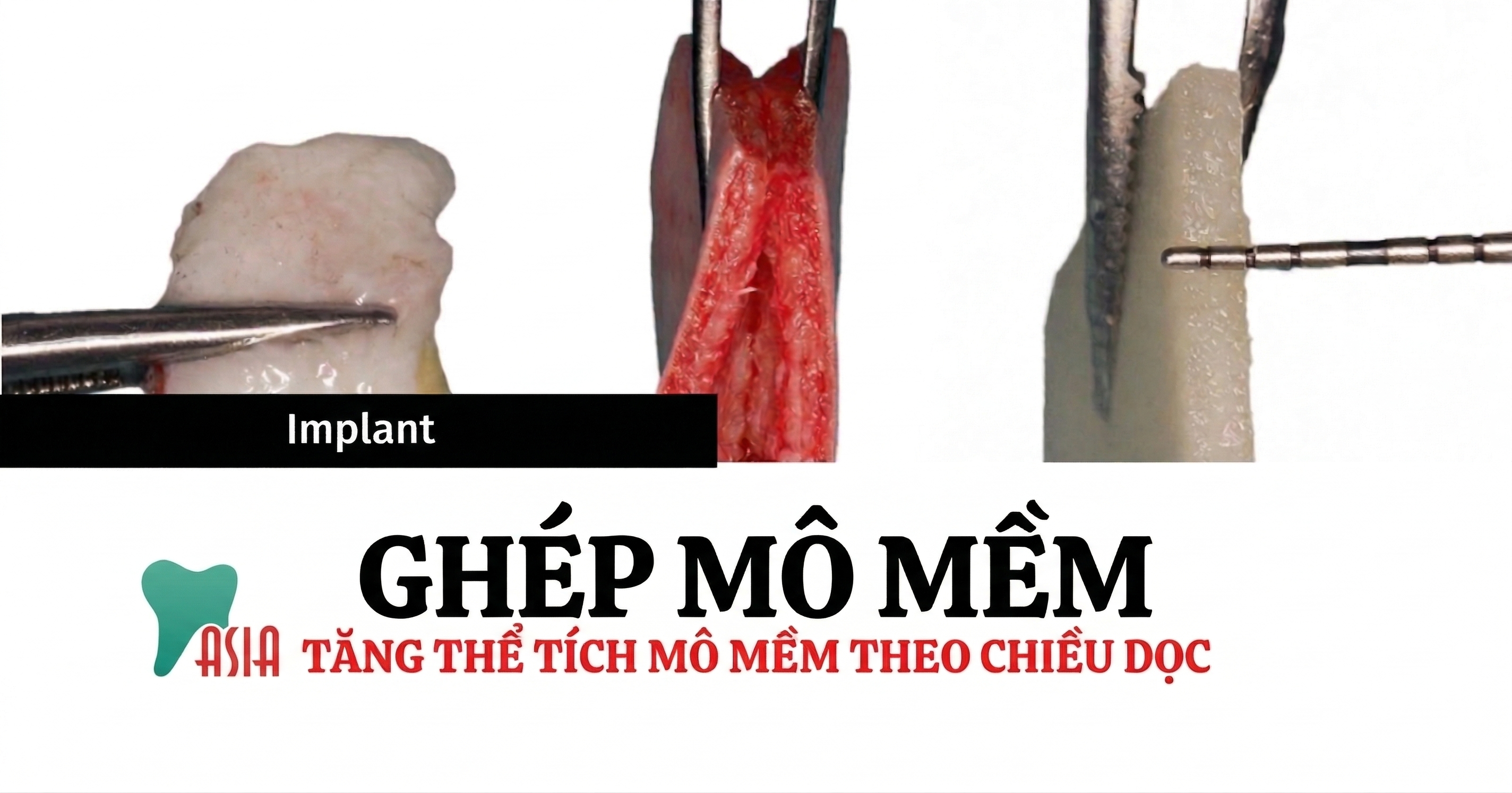 Ghép Mô Mềm Theo Chiều Dọc Trong Implant: Kỹ Thuật & Vật Liệu (2026)