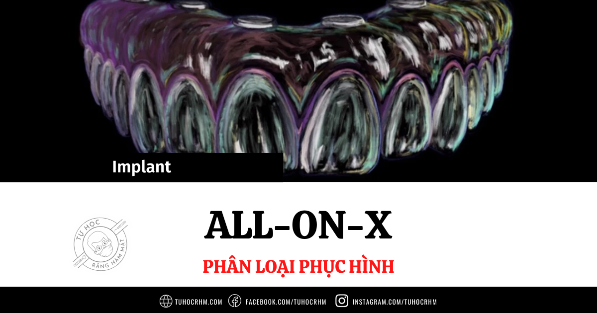 Phân Loại Các Phục Hình Toàn Hàm Trên Implant All-on-X (2026)