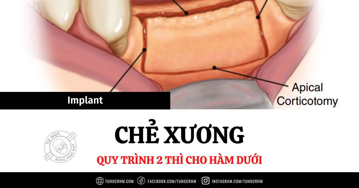 Ghép Nướu Tự Do (FGG): Chỉ Định, Kỹ Thuật & Biến Chứng (2026)