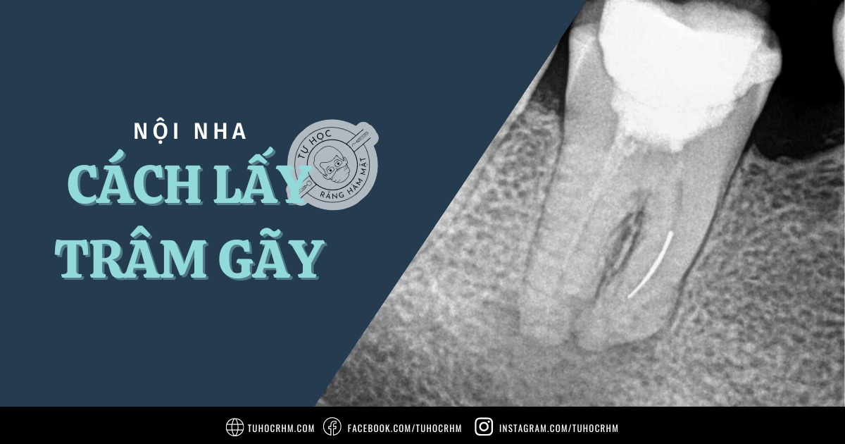 Đặt Implant Dưới Mào Xương Ổ: Kỹ Thuật & Hiệu Quả Lâm Sàng (2026)