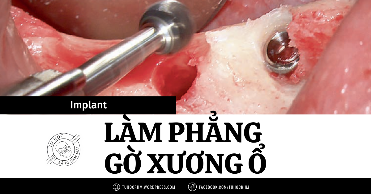 Làm Phẳng Gờ Xương Ổ Trong Implant: Kỹ Thuật & Hiệu Quả (2026)