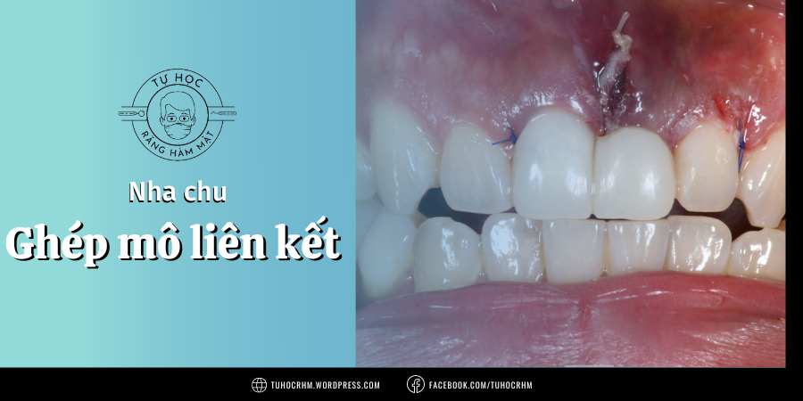 Ghép Mô Liên Kết (SCTG): Kỹ Thuật Che Phủ Chân Răng & Tăng Thể Tích Nướu