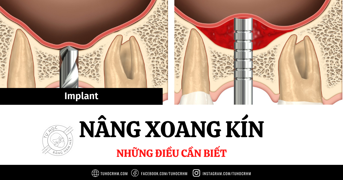 Kỹ Thuật Nâng Xoang Kín Trong Implant: Chỉ Định & Các Phương Pháp (2026)
