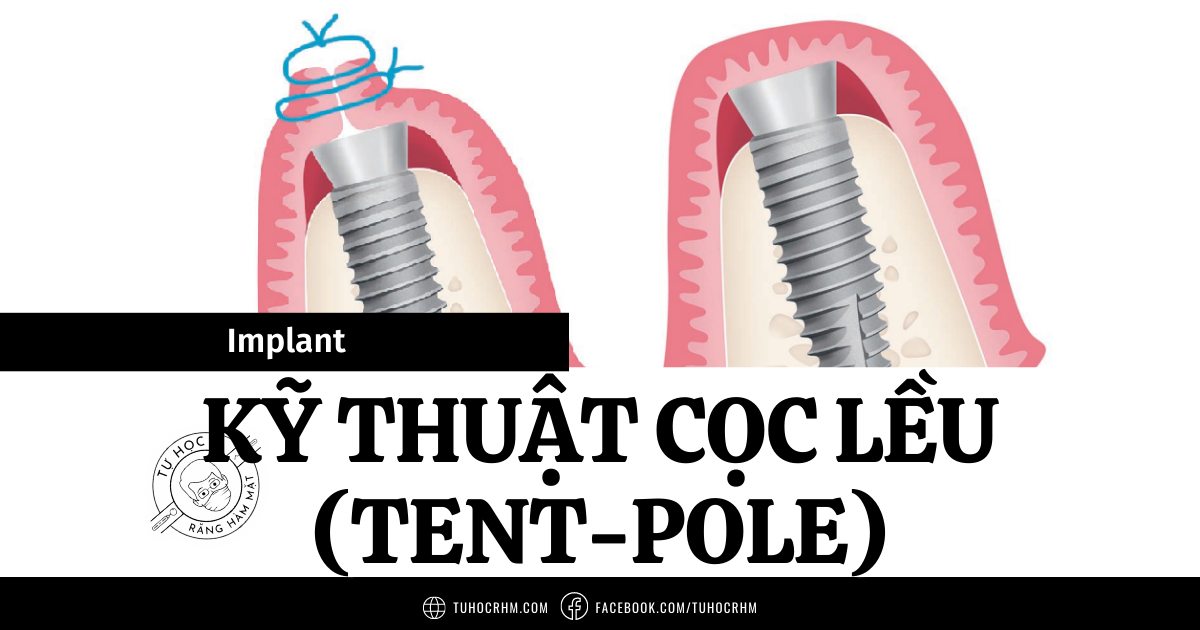 Kỹ Thuật Cọc Lều Tăng Thể Tích Mô Mềm Trong Implant (2026)