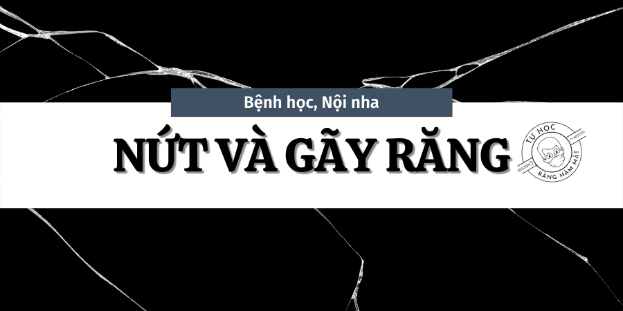 Nứt Và Gãy Răng (P2): Gãy Dọc Chân Răng (VRF) - Nguyên Nhân & Chẩn Đoán