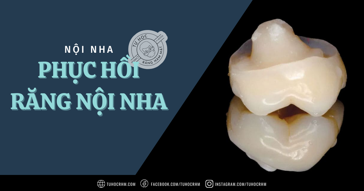 Chiến Lược Phục Hồi Răng Sau Nội Nha: Khi Nào Cần Đặt Chốt? (2026)