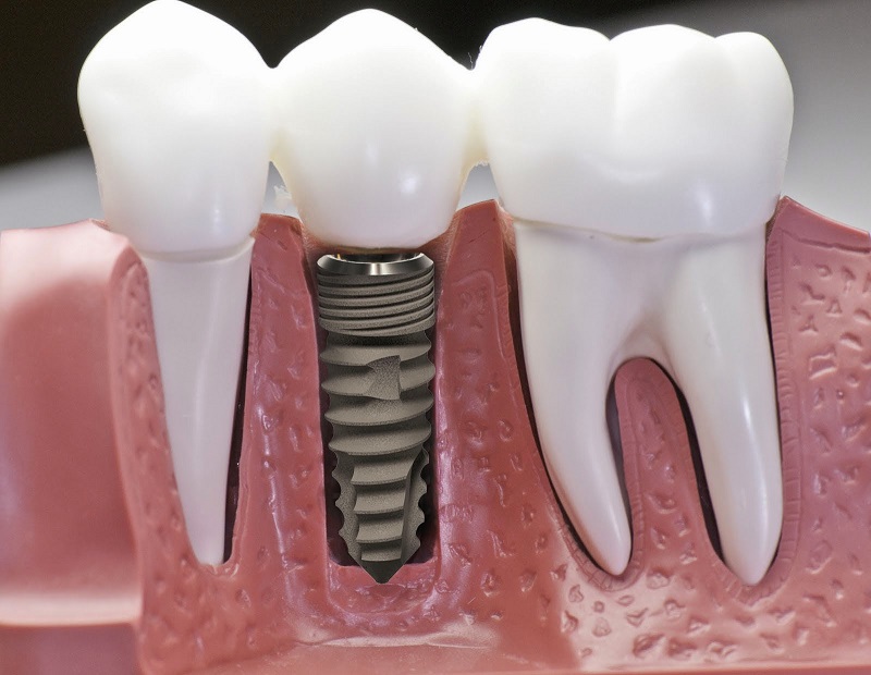 Cắm Ghép Implant Là Gì? Quy Trình & Thời Điểm Vàng Để Trồng Răng (2026)