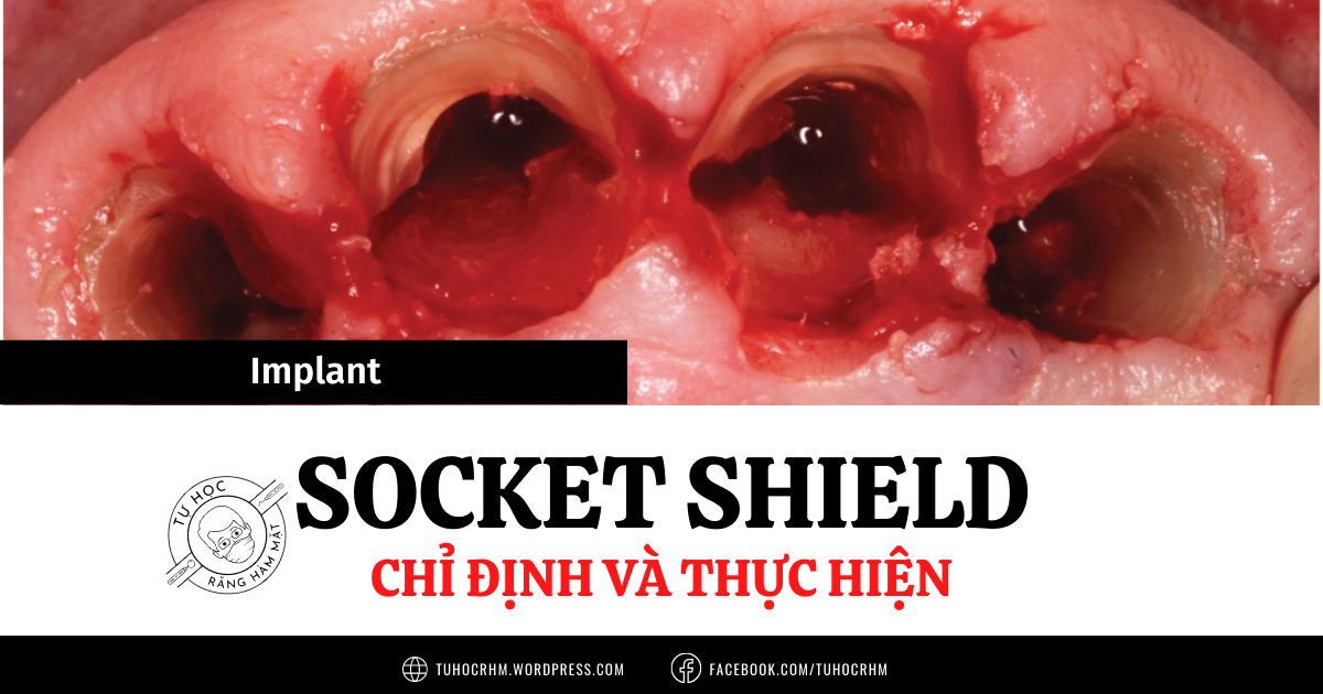 Kỹ Thuật Socket Shield Trong Implant: Bảo Tồn Xương Mặt Ngoài Tuyệt Đối
