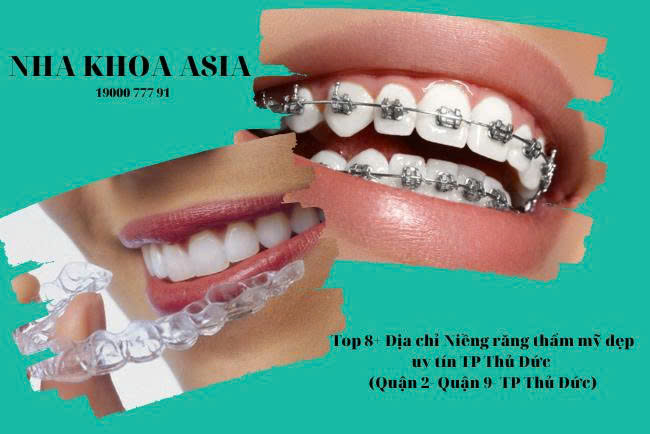 Niềng răng thẩm mỹ